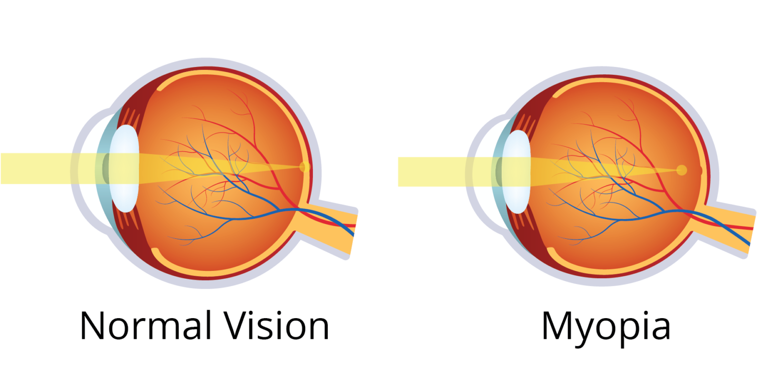 What Is Myopia (Nearsightedness)? Symptoms & Treatment