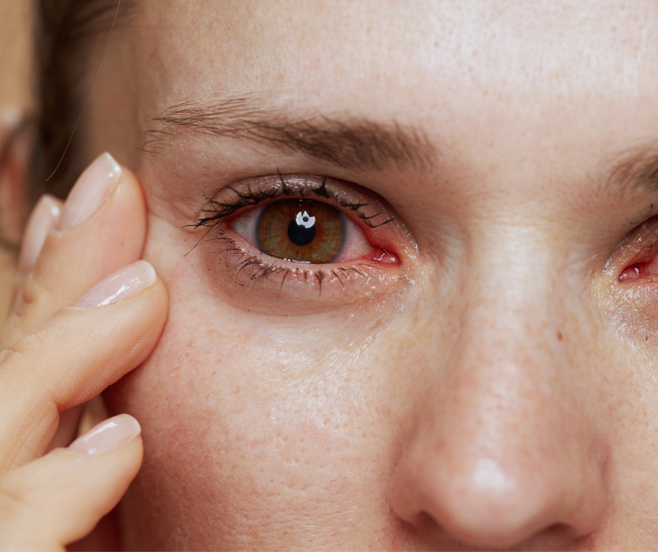 A woman suffering from dry eye due to stress