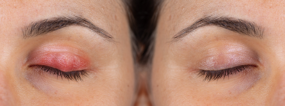 Eye infection at beauty salon