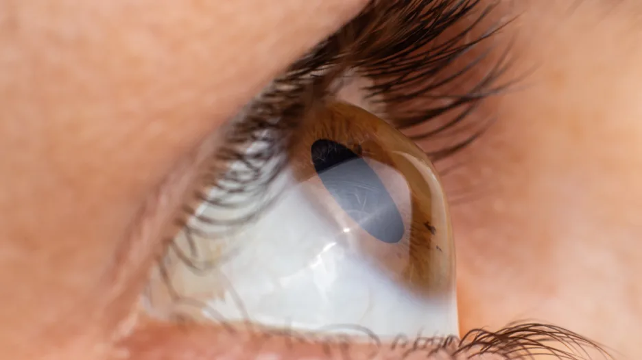 Astigmatism