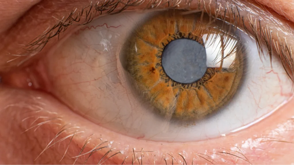 What Are Cataracts