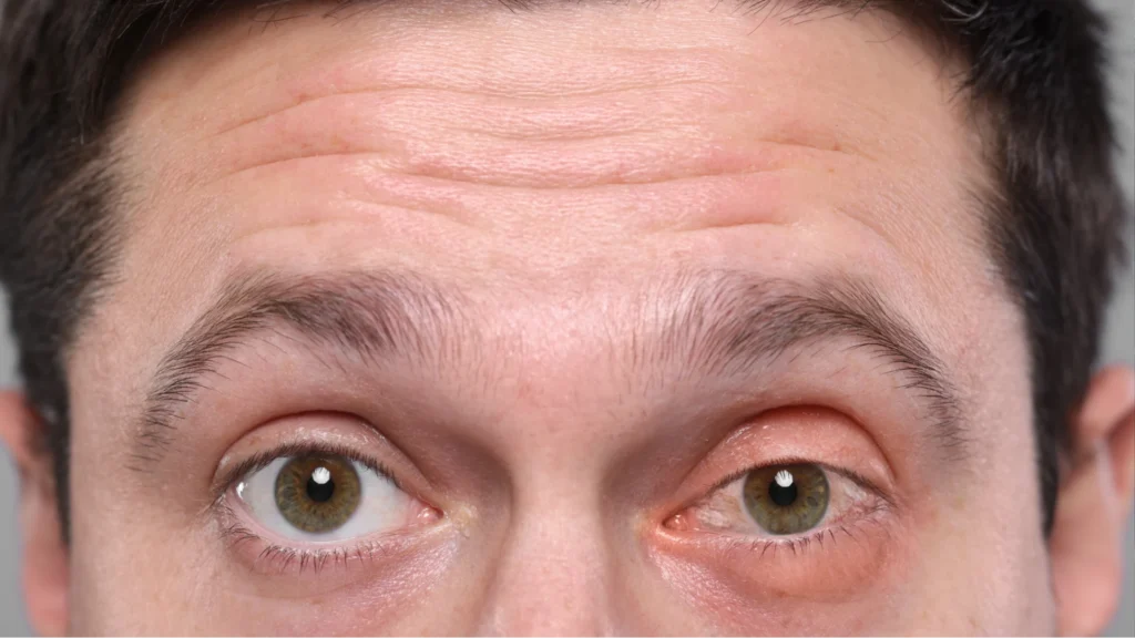 Blepharitis Treatment