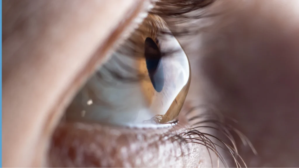 Keratoconus Treatment in Ontario