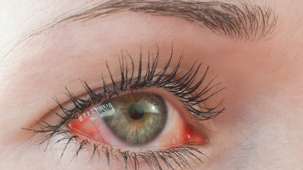 Close-up of a green eye with a red, bloodshot white and visible irritated blood vessels, showing signs of eye irritation from a foreign object or scratched cornea.